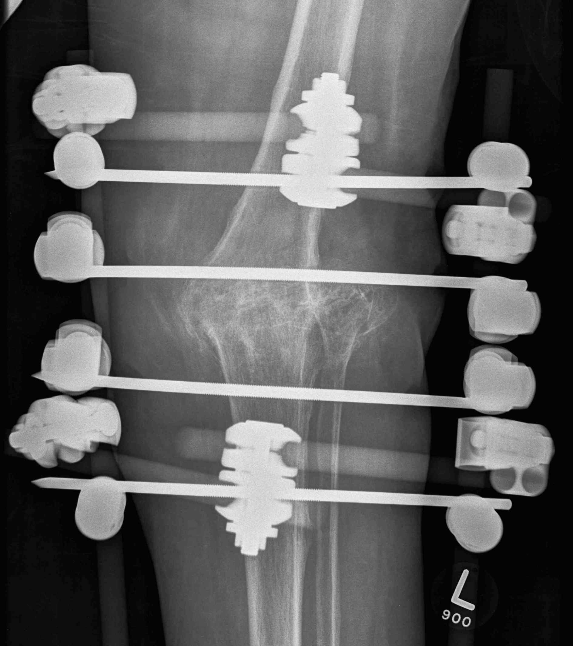 Knee Fusion External Fixation